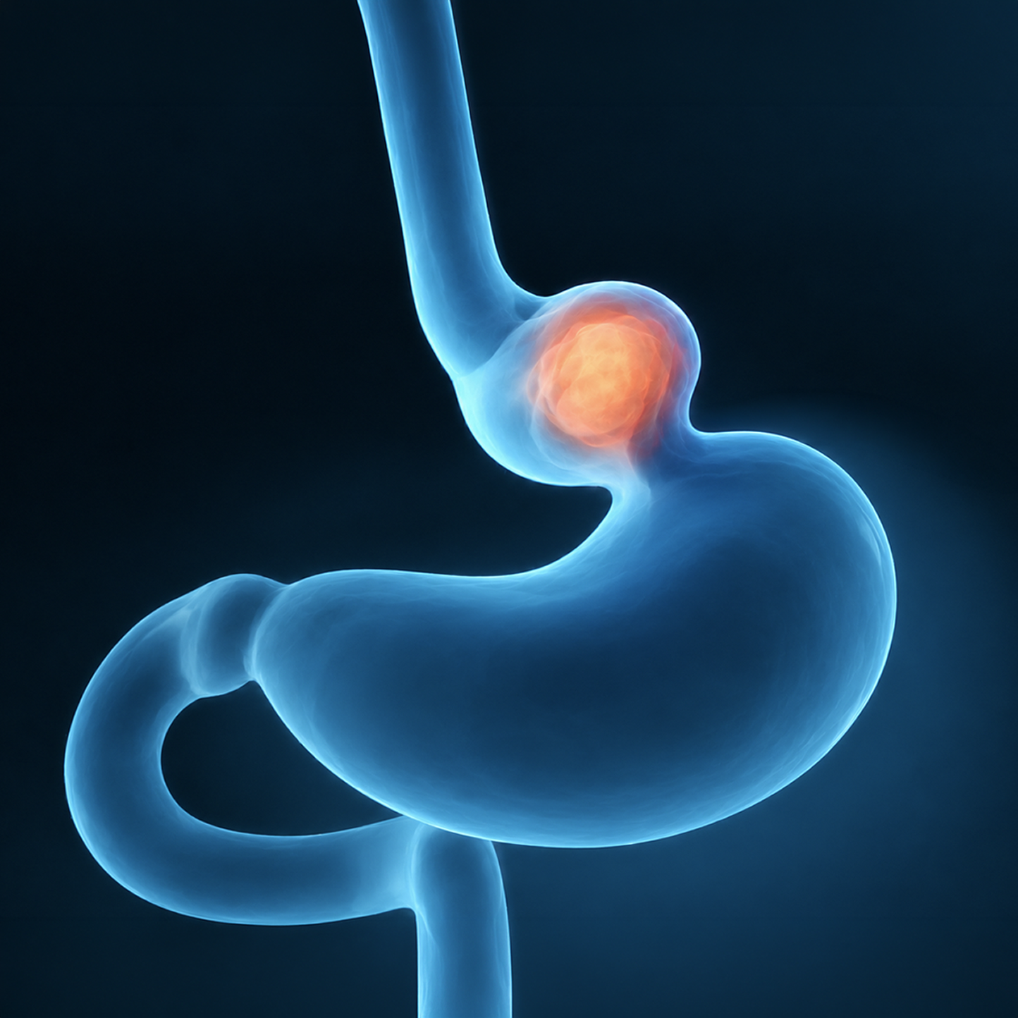 Hiatal Hernia Illustration