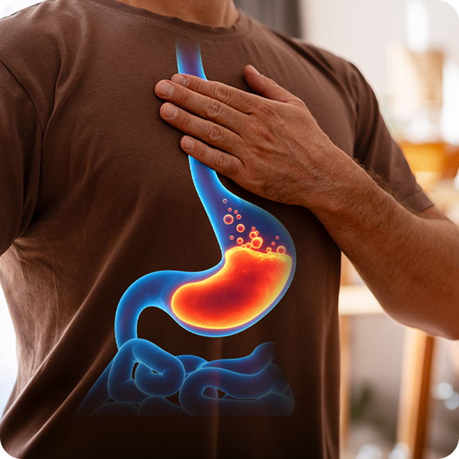 Hiatal Hernia Illustration