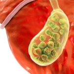 Gallstones-150x150-1.jpg