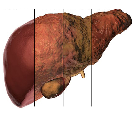 liver-cancer-types-1.jpg